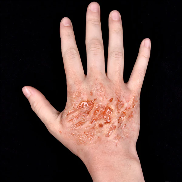 Peel N' Stick Prosthetics, Burn (Large) - Image 3