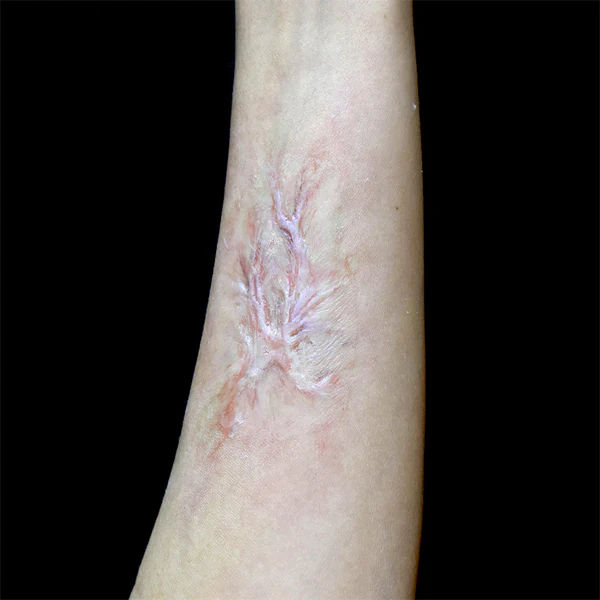 Peel N' Stick Prosthetics, Healed Burn Scar 3 - Image 3