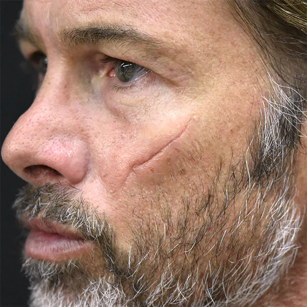 Peel N' Stick Prosthetics, Sunken Scar 7 - Image 3